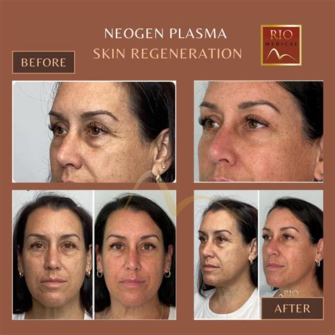 neogen plasma side effects